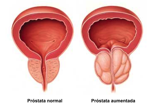Hiperplasia da Próstata