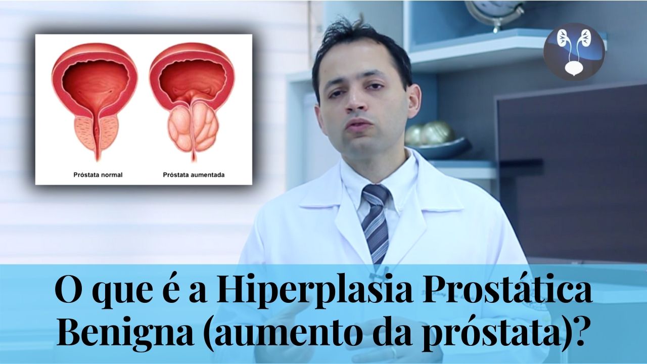 O que e a Hiperplasia Prostatica Benigna - aumento da prostata
